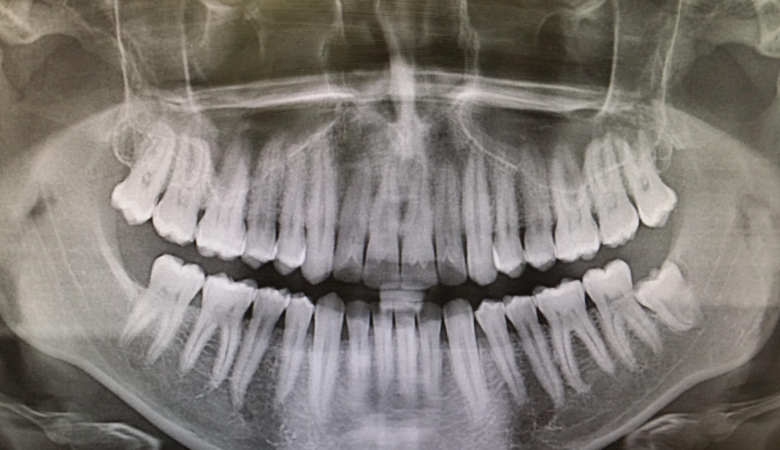 Dişlerin Yeniden Büyümesini Sağlayan İlaç Geliştiriliyor