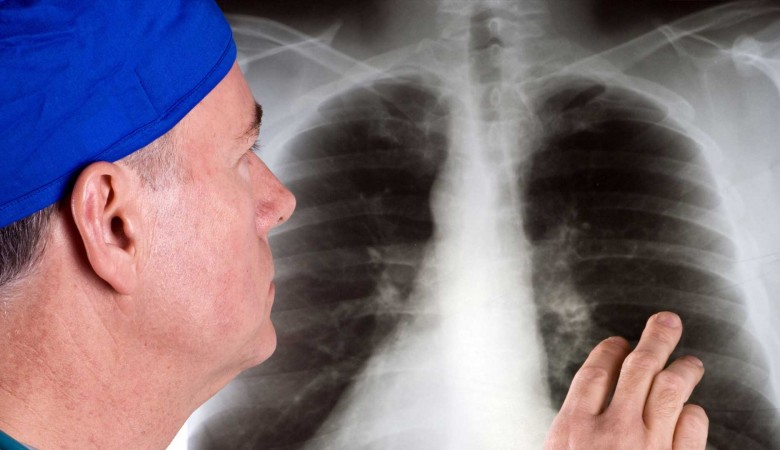 AstraZeneca’nın “durvalumab” Etkin Maddeli İlacı Akciğer Kanseri Sonuçları Olumlu
